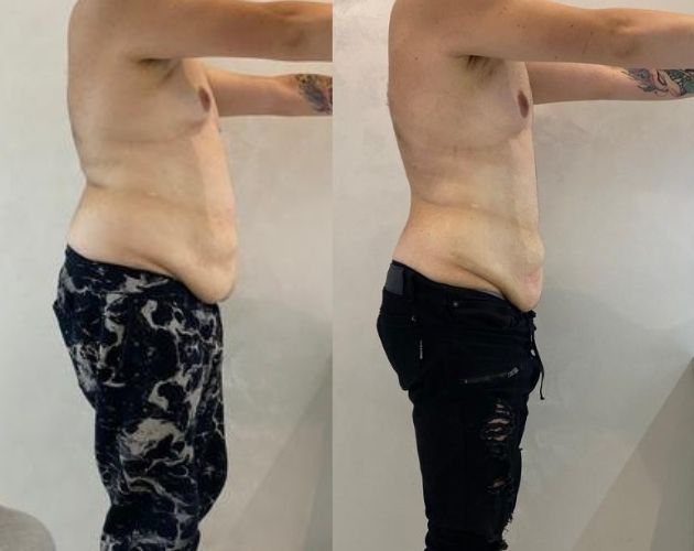 Medycyna estetyczna Liposukcja laserowa przed i po wellclinic efekty metamorfoza Wellclinic
