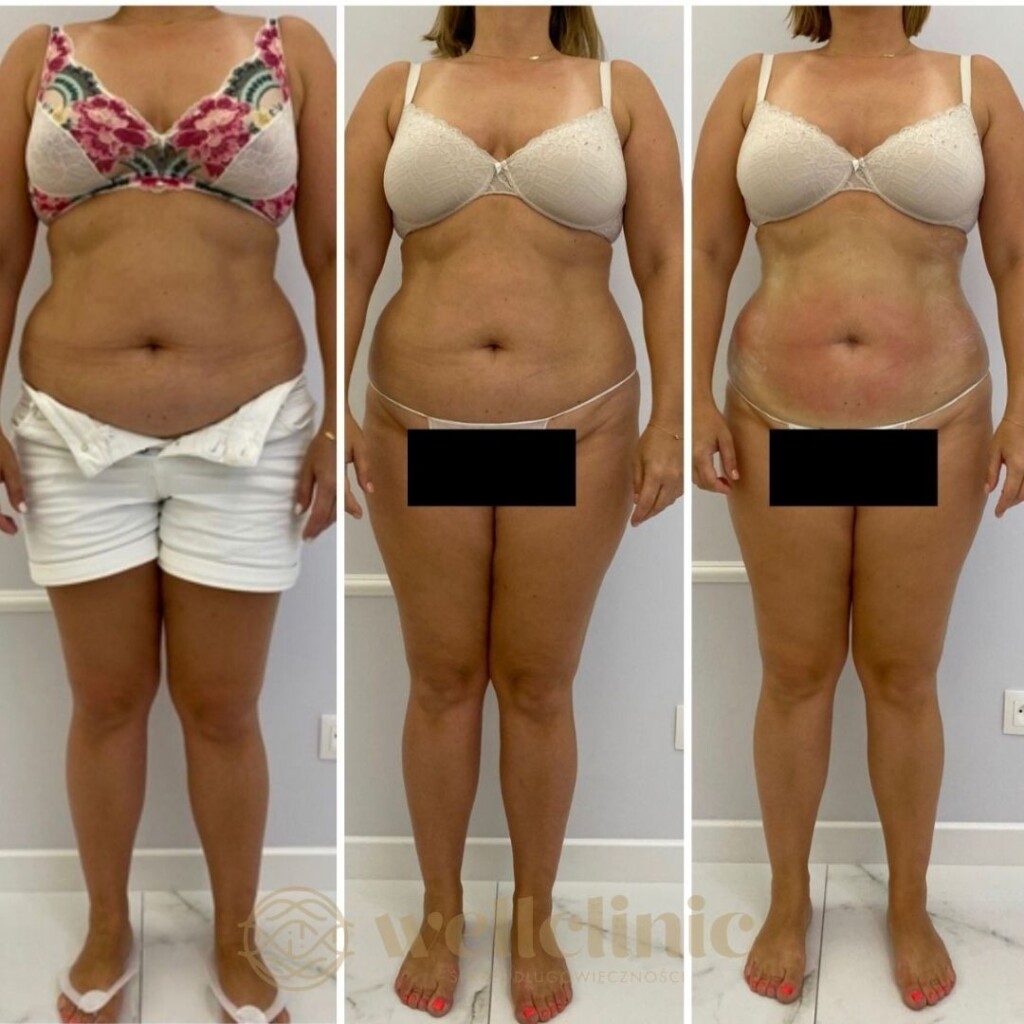 Effects of body shaping liposuction warszawa