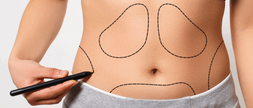 Fettsuging med laser - Tight Sculpting