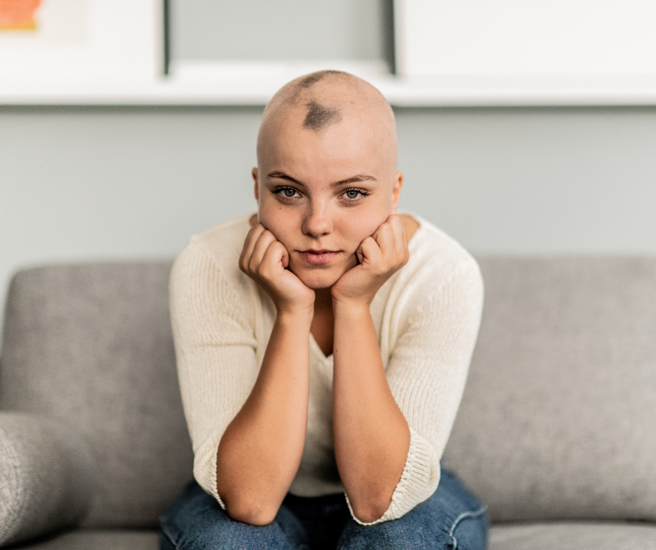Alopecia areata