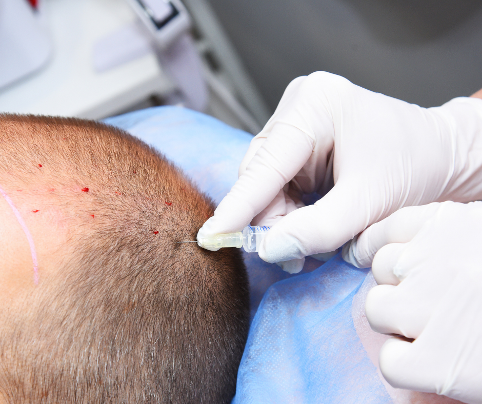 Behandlung von Alopezie mit plättchenreichem Plasma