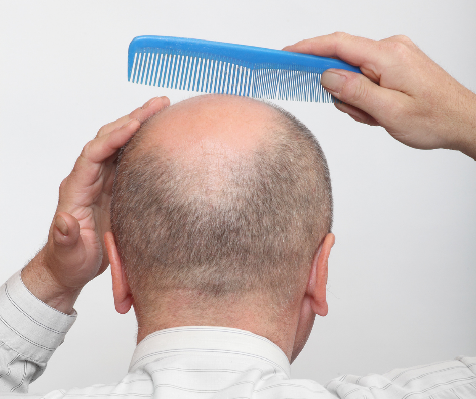 Androgenetische Alopezie
