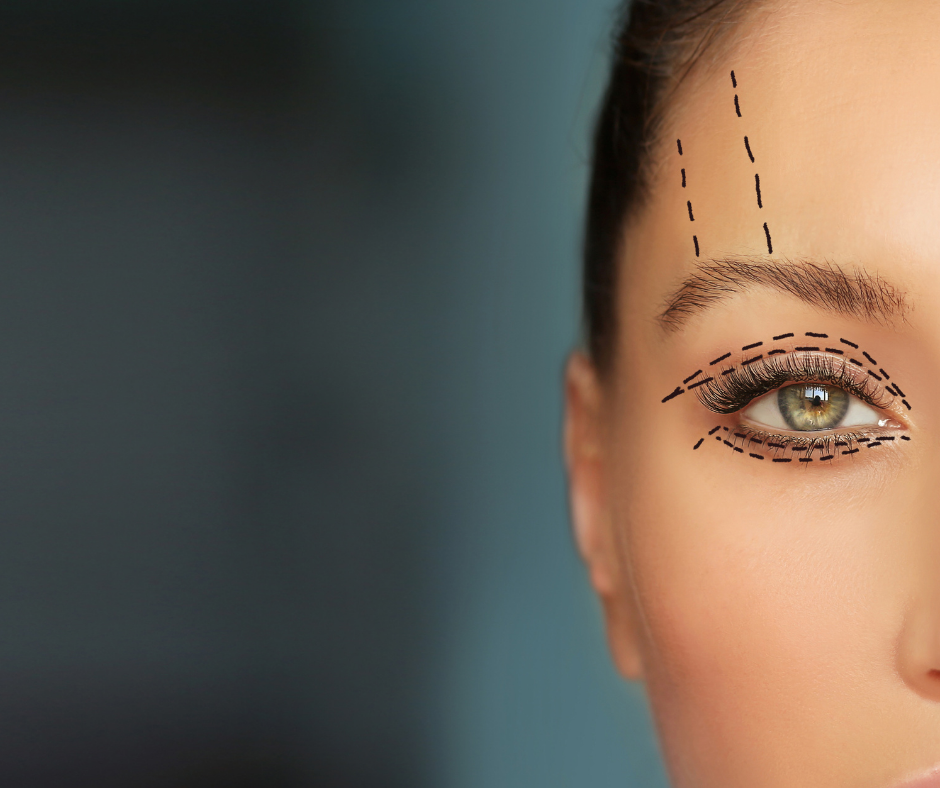 Blefaroplastyka