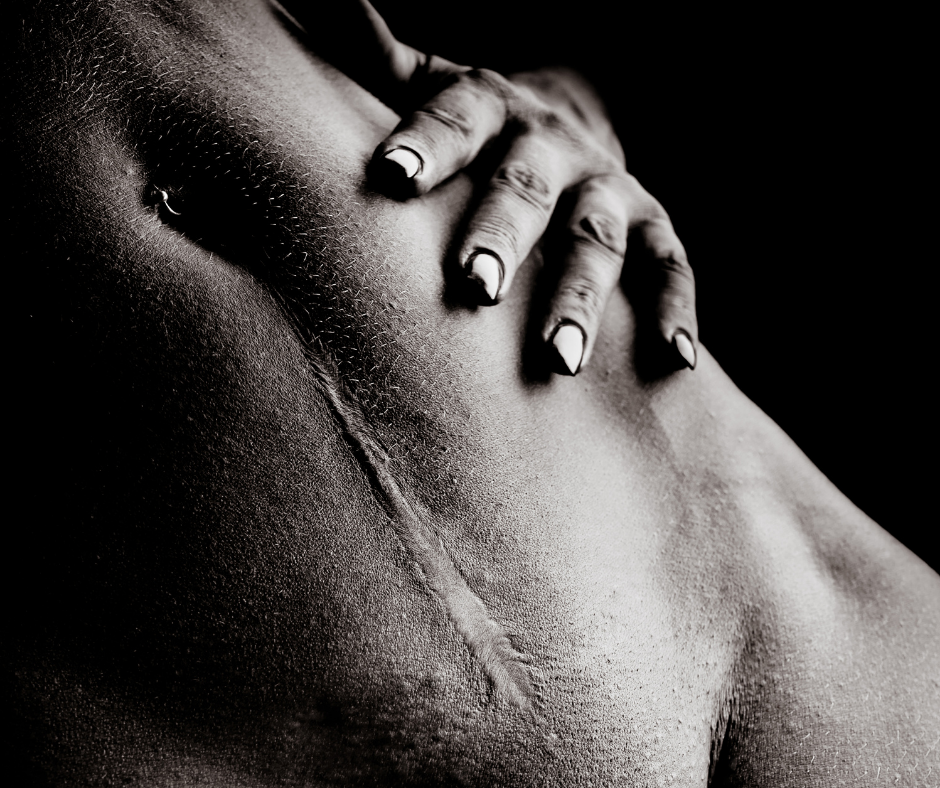 Immature scars