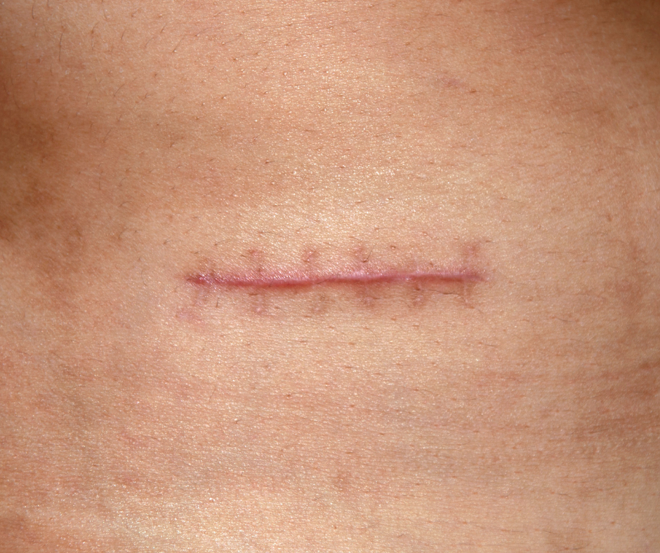 Pathological scars