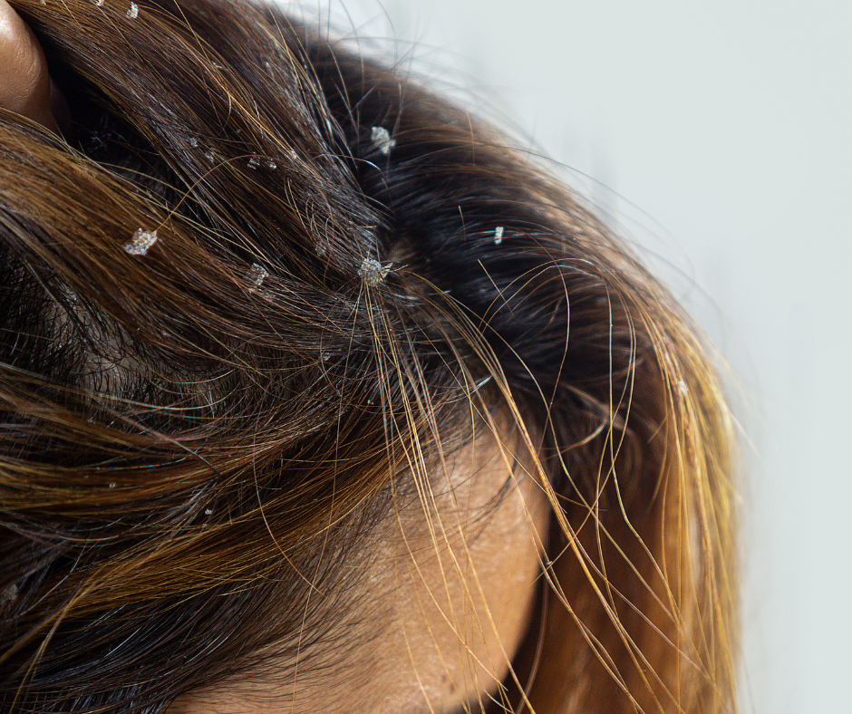 Dandruff