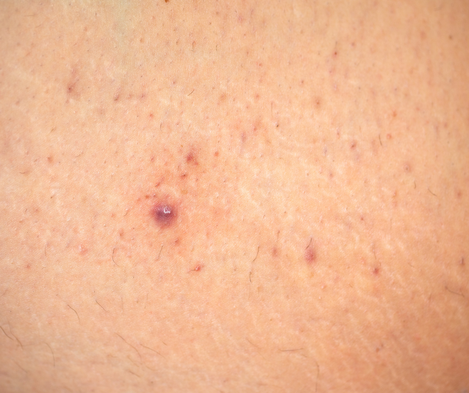 Folliculitis