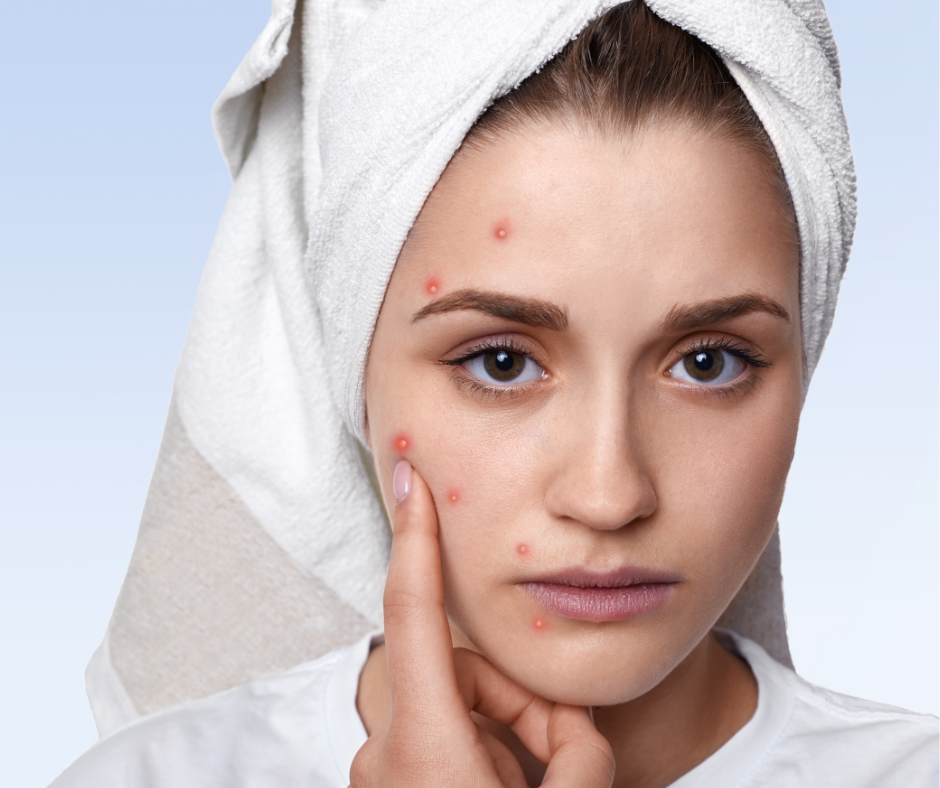 Acne rosacea