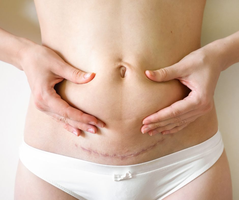 Endometriose-Entfernungsnarbe - wie wird sie entfernt?
