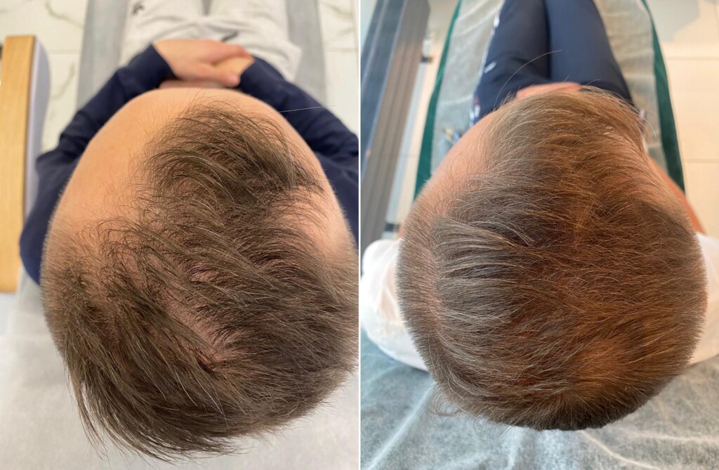 Behandlung von Alopezie in der Wellclinic
