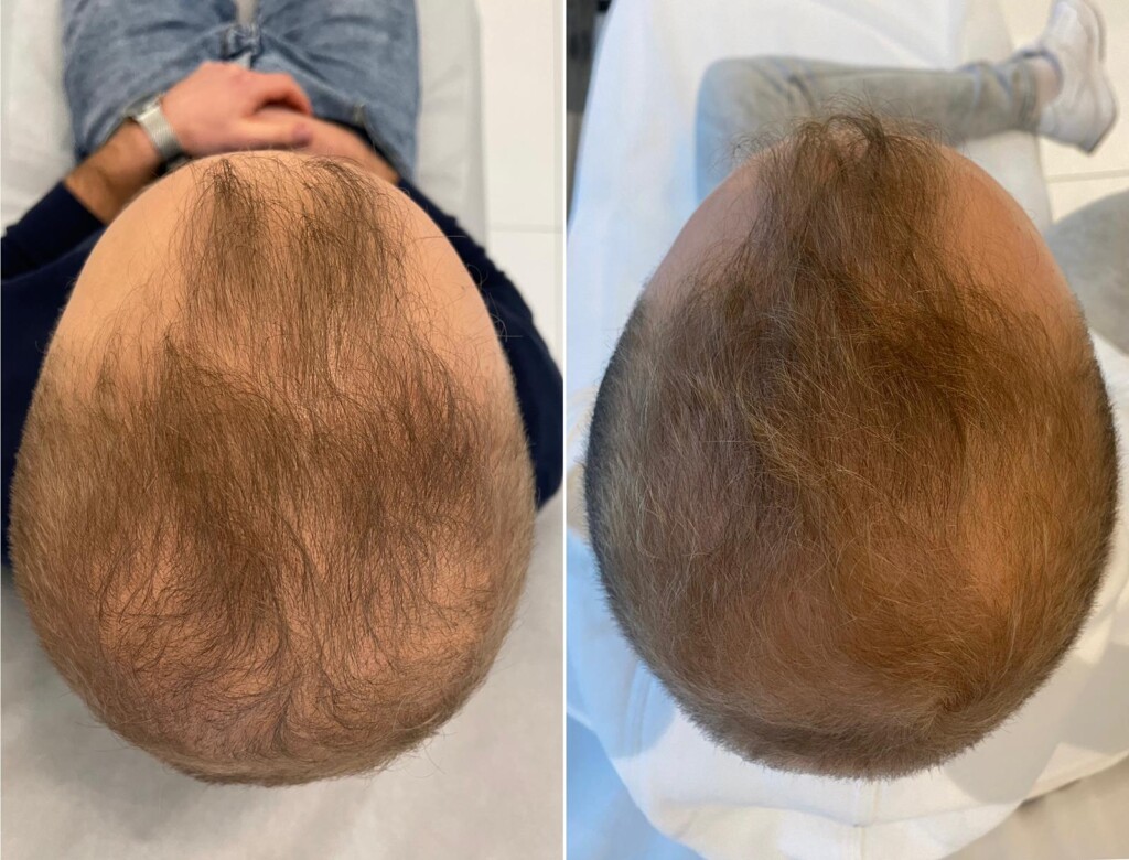 Behandlung von Alopezie in der Wellclinic