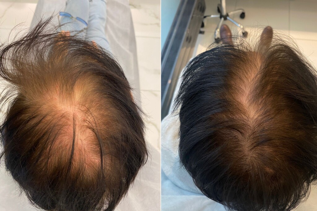 Haartransplantation und die Behandlung von Alopezie