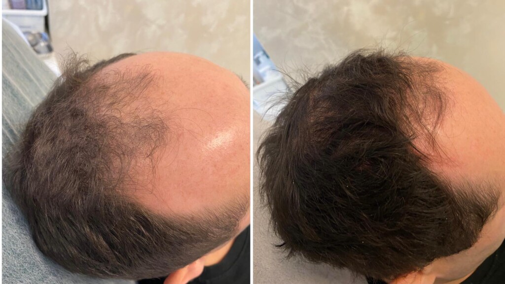Behandlung der androgenetischen Alopezie
