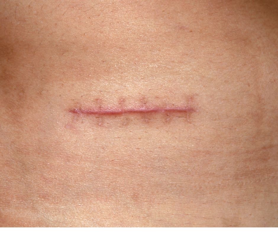 Surgical scars