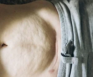 Abdomen etter fødselen
