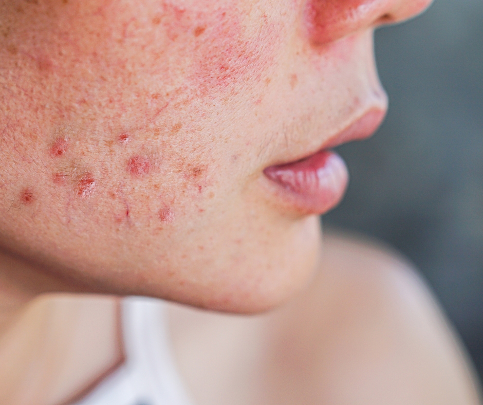 Pimples