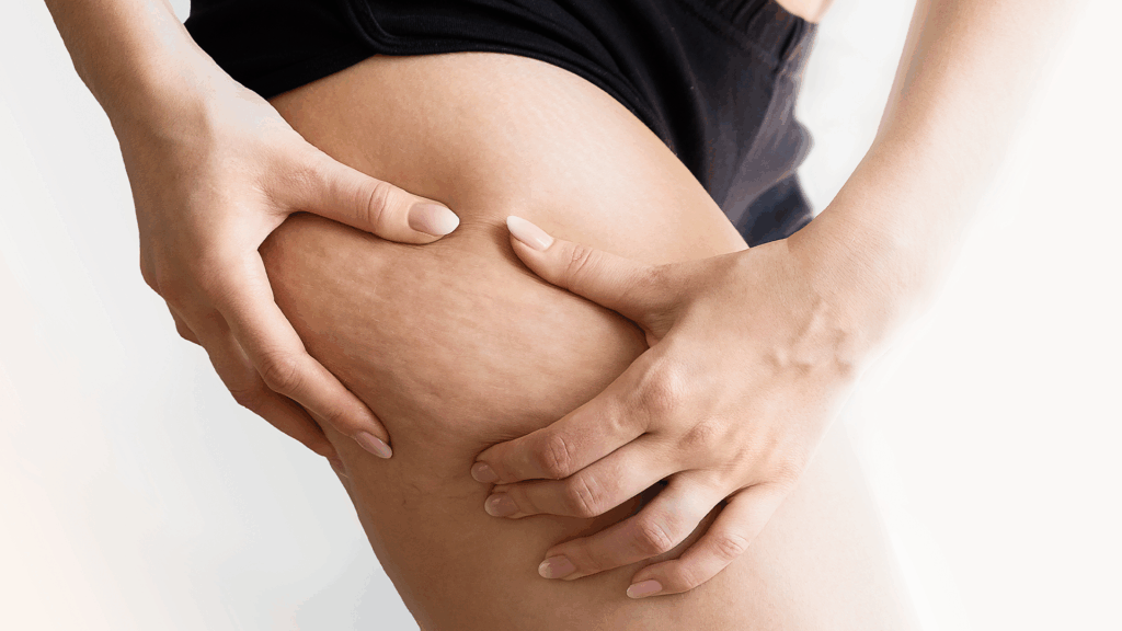 Cellulite-Reduktion