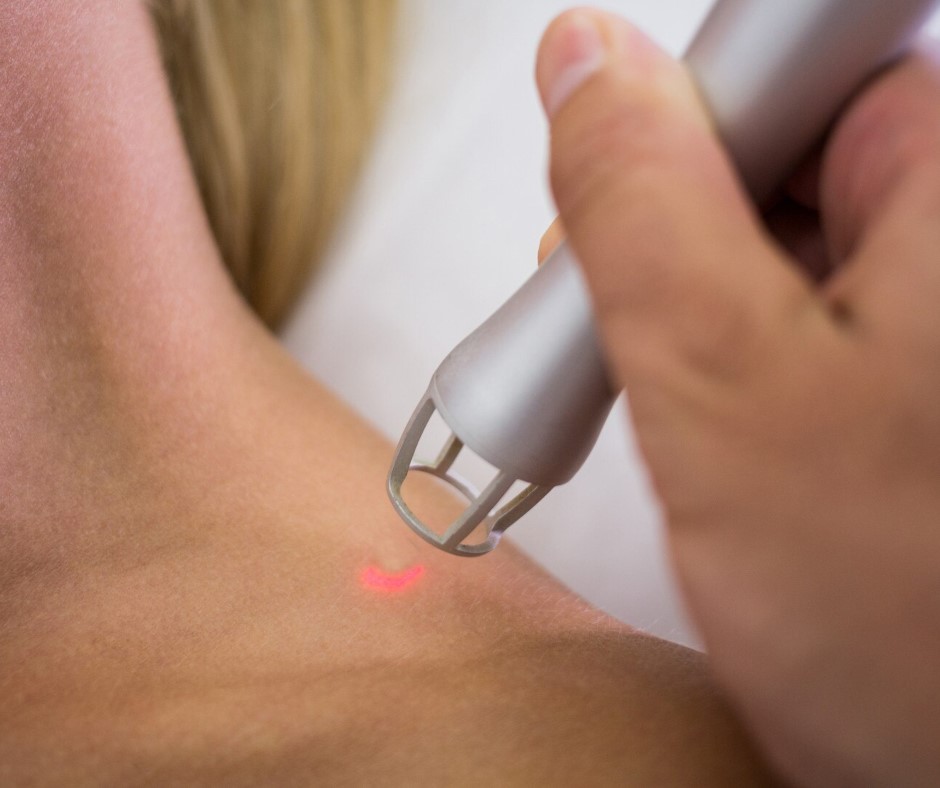 Ablacja laserowa
