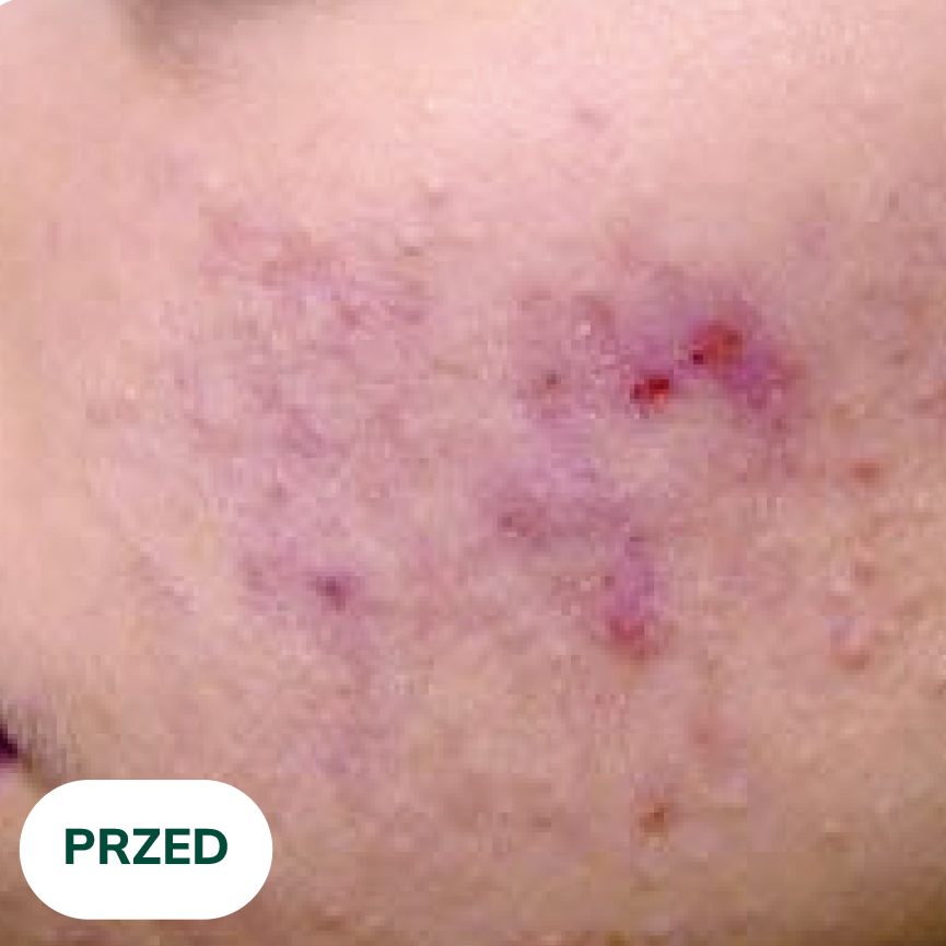 Przed