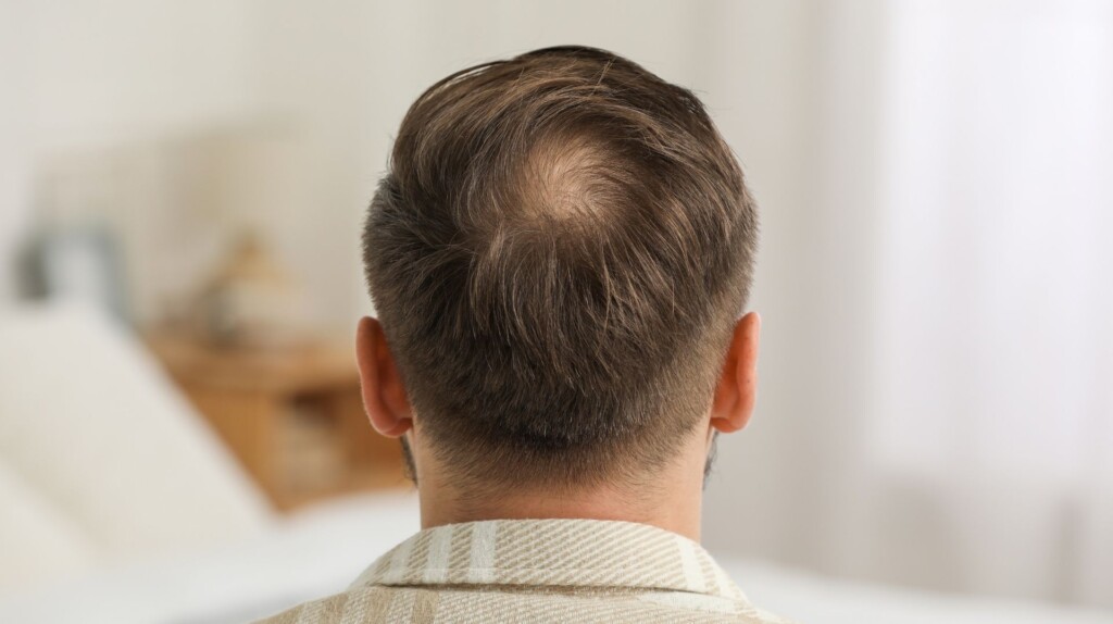 androgenetisk alopecia